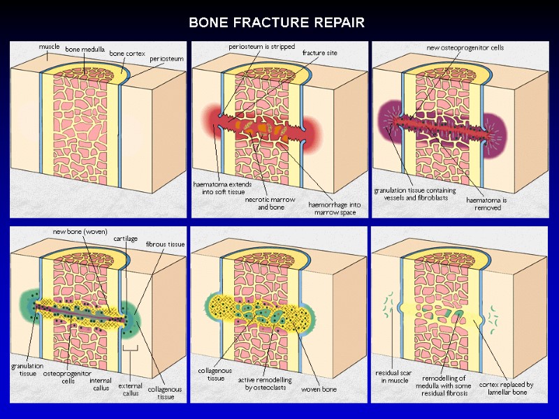 BONE FRACTURE REPAIR